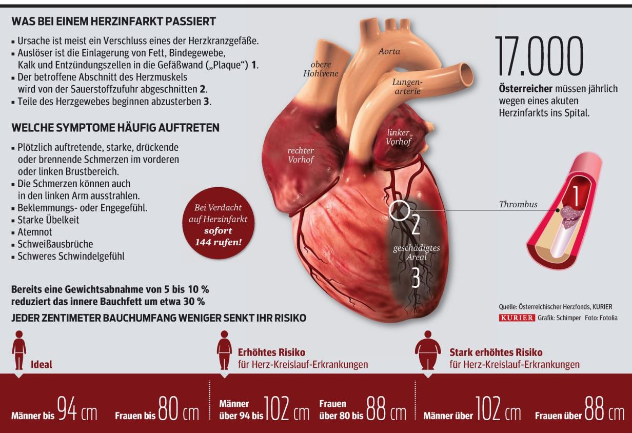 Unterschied Zwischen Schlaganfall Und Herzinfarkt