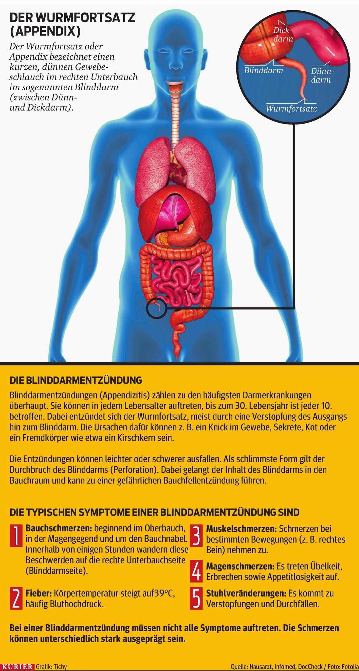 Blinddarm-OP: Antibiotika statt unters Messer | kurier.at
