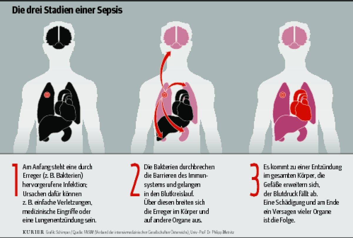Wie Lange Dauert Eine Blutvergiftung kurier.at