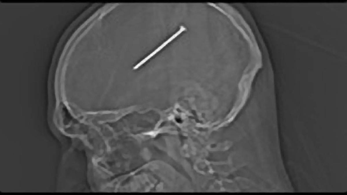 Weltweit erste Operation zur PenisVerkleinerung kurier.at