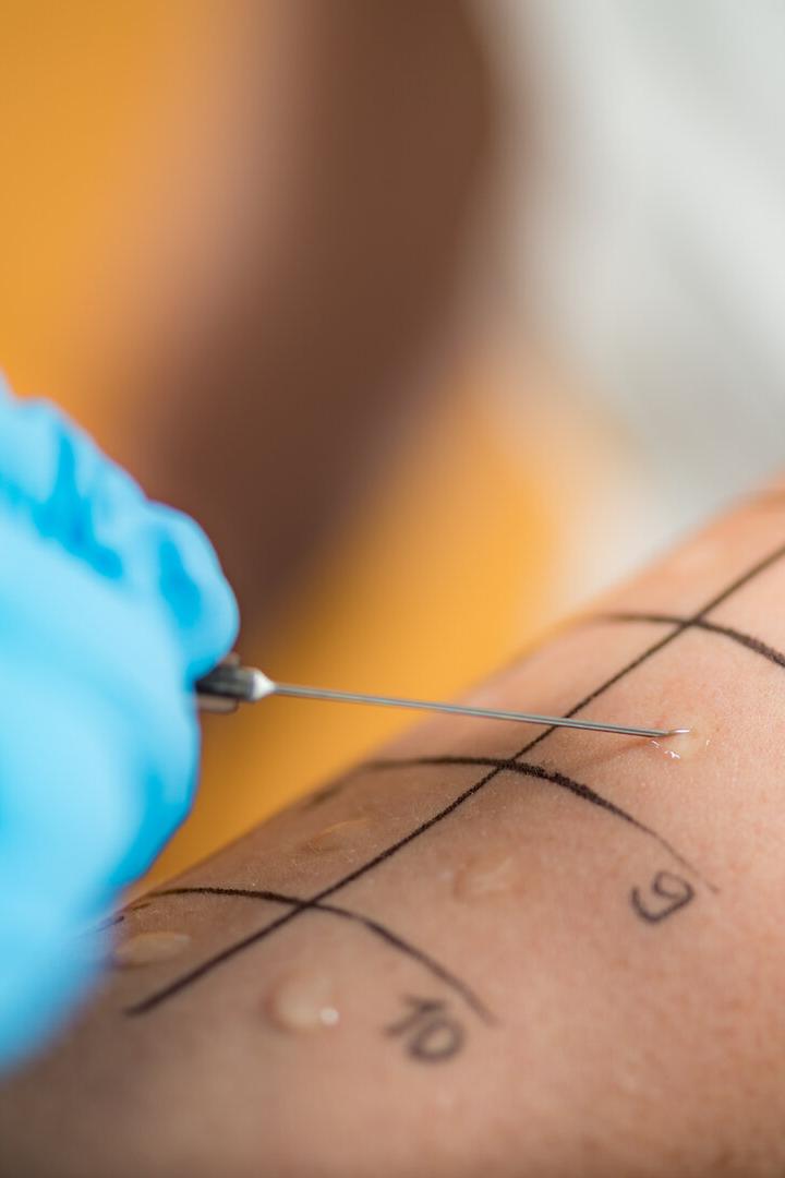 Skin Prick Allergy Testing