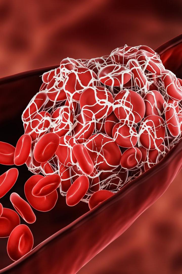 Blood Clot or thrombus blocking the red blood cells stream within an artery or a vein 3D rendering illustration. Thrombosis, cardiovascular system, medicine, biology, health, anatomy, pathology concepts.