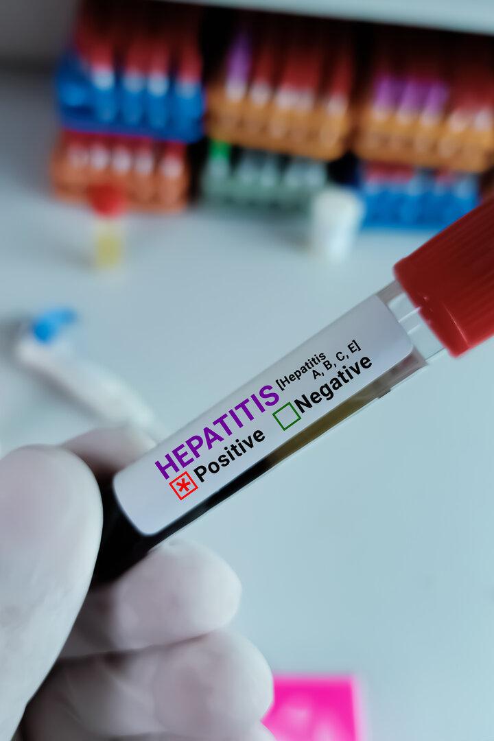 Hepatitis-Virus-Test in Händen eines Labormitarbeiters.