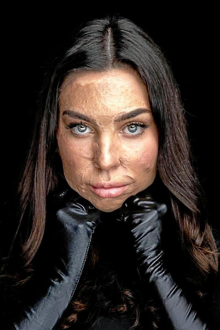 Mafalda Da Silva Baptista lebt mittlerweile schmerzfrei – ihre Narben bleiben für immer. 