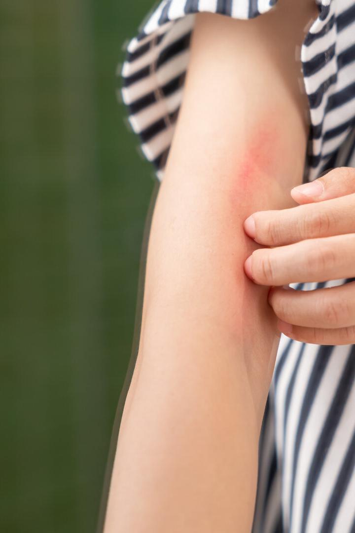 skin problem and beauty. Young woman scratch body has itchy skin from skin allergic, steroid allergy, sensitive skin, red from sunburn, chemical allergy, rash, insect bites, Seborrheic Dermatitis.