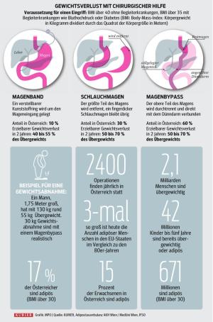 Magen-OP verlängert das Leben | kurier.at