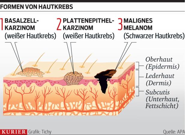 Neue Therapien gegen weißen Hautkrebs