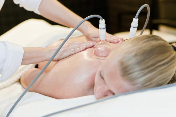Eine Frau erhält eine Schröpfmassage auf dem Rücken.