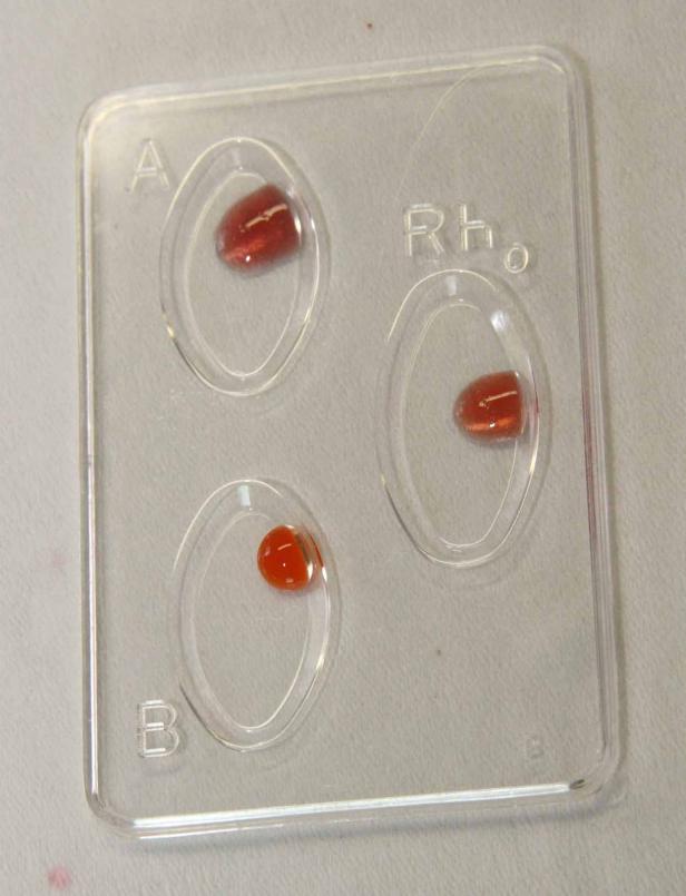 Eine Blutgruppenbestimmung zeigt Agglutination bei A und Rhesus positiv.