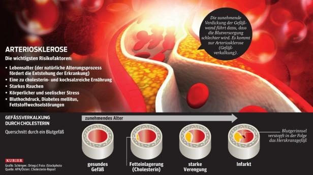 Gefäßverkalkung auch von außen