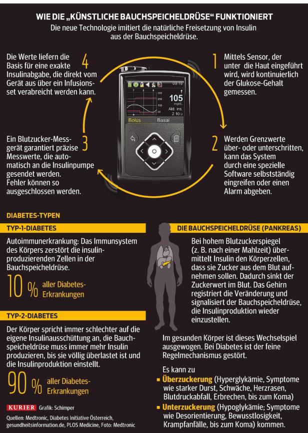 Eine Infografik erklärt die Funktionsweise einer künstlichen Bauchspeicheldrüse zur Insulinabgabe bei Diabetes.