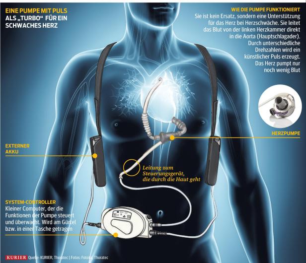 Weltpremiere: Blutpumpe mit Puls