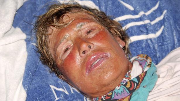 Das Gesicht einer Frau mit starkem Sonnenbrand liegt auf einer blau-weiß gestreiften Decke.