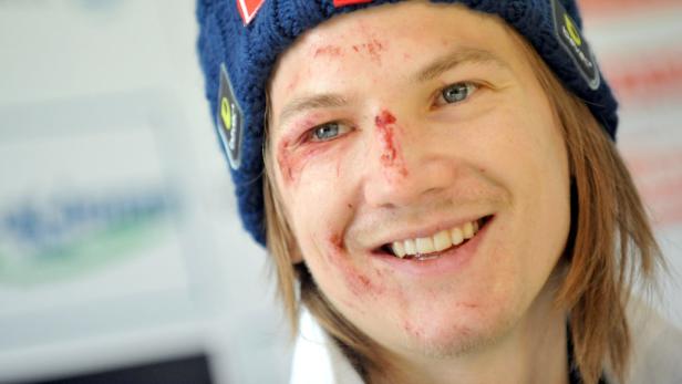 Ein Mann mit blauen Augen und blutigen Schrammen im Gesicht lächelt in die Kamera.