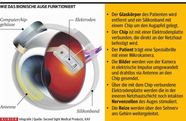Erblindete Wienerin bekam bionisches Auge