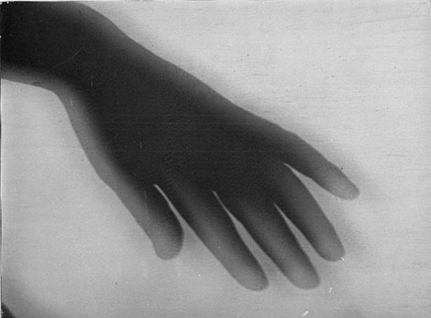 Ein Röntgenbild einer menschlichen Hand.