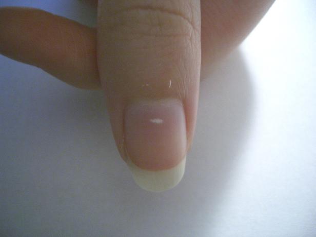 Ein Finger mit einem weißen Fleck auf dem Fingernagel.