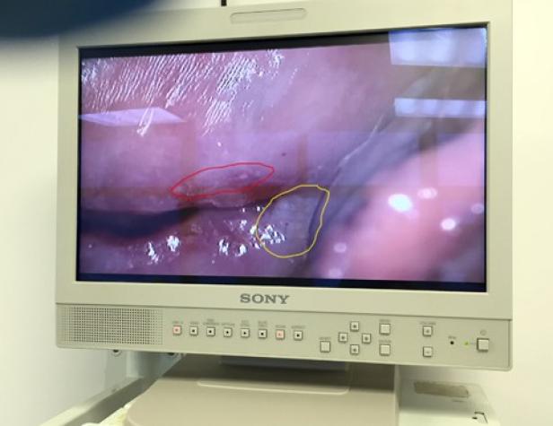 Ein Sony-Monitor zeigt eine Nahaufnahme einer Hautoberfläche mit Markierungen.