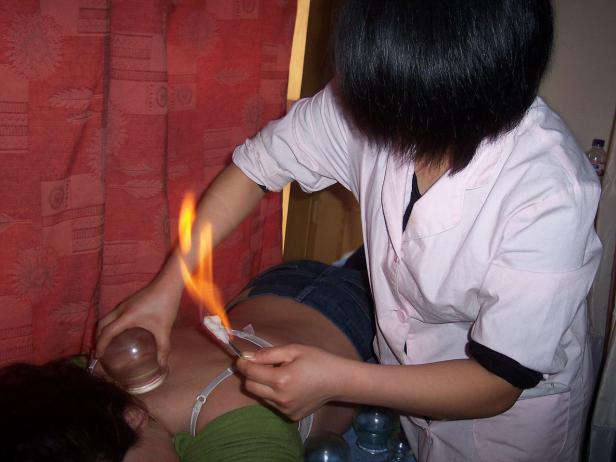 Für Risikofreudige: Chinesische Feuermassage