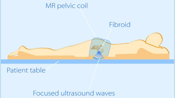 Eine schematische Darstellung einer Behandlung von Myomen mit fokussiertem Ultraschall.