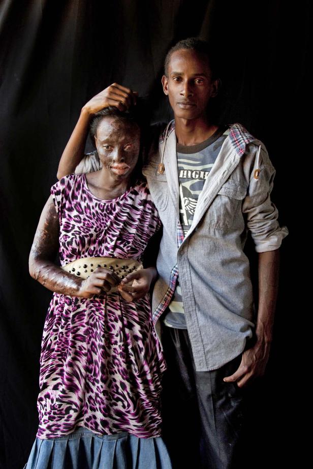 Ein Paar steht vor einem schwarzen Hintergrund, die Frau mit Brandnarben im Gesicht und an den Armen.