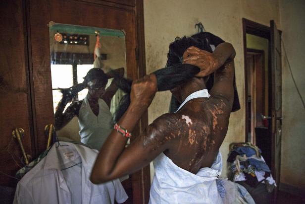 Eine Frau mit Verbrennungen kämmt sich vor einem Spiegel.