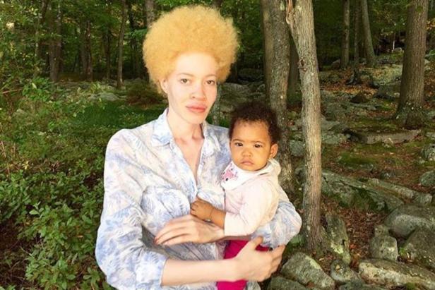 Albino-Model Forrest - Alles andere als farblos