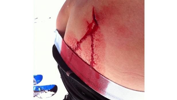 Eine klaffende Wunde am Rücken einer Person blutet stark.