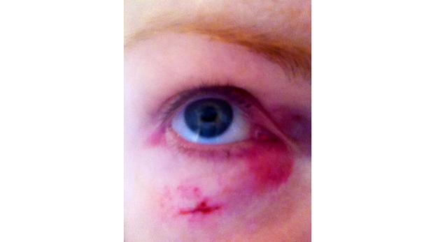 Nahaufnahme eines blauen Auges mit einer Prellung und einer kleinen Schnittwunde im Gesicht.