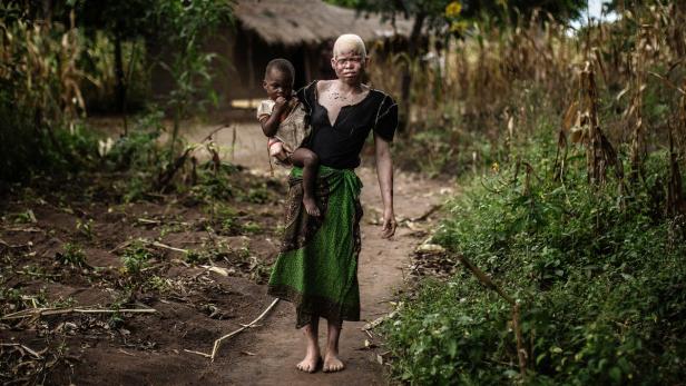 Albinismus: Amnesty prangert Menschenjagd in Malawi an