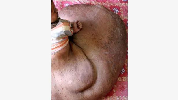 Ein Kind liegt neben einem Mann mit einem großen Tumor am Rücken.