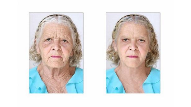 Eine ältere Frau, deren Gesicht vor und nach einer kosmetischen Behandlung gezeigt wird.
