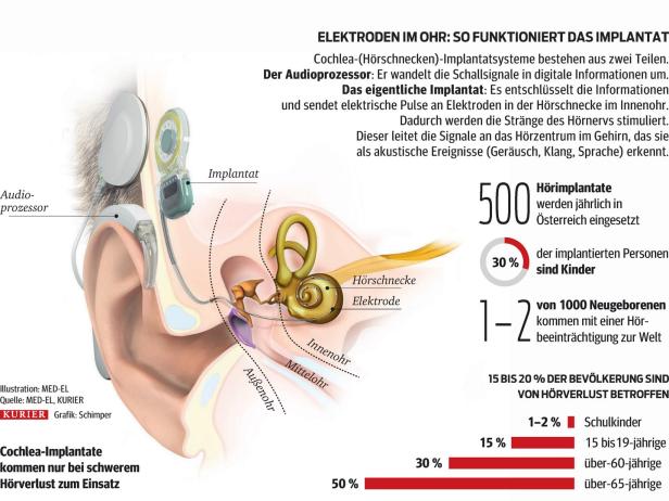 Innenohr-Implantat: "Unsagbar schön, wieder Baulärm zu hören"