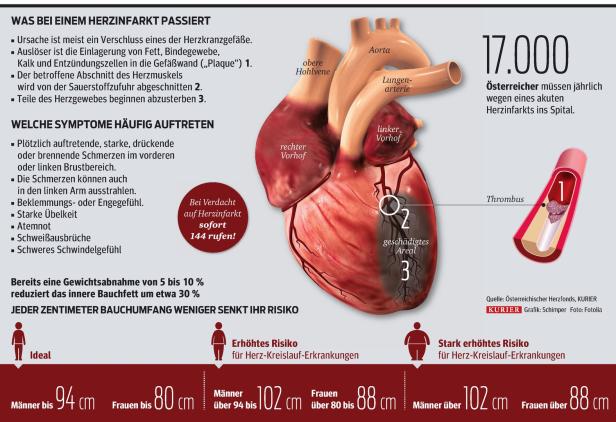 Genauere Vorhersage von Herzinfarkt und Schlaganfall möglich