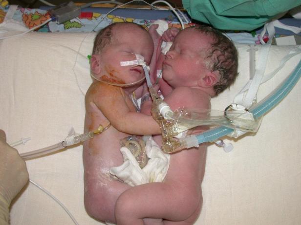 Siamesische Zwillinge vor 10 Jahren getrennt