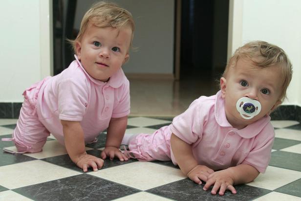 Siamesische Zwillinge vor 10 Jahren getrennt
