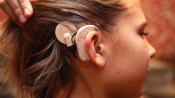 Wie Implantate das Hören ersetzen