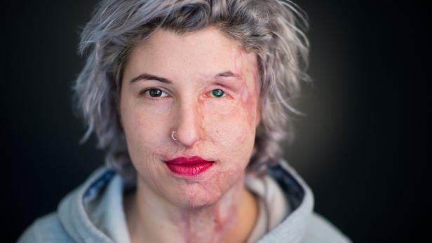Dpa-Story - Säureopfer Vanessa zeigt Gesicht Dpa-Story - Säureopfer Vanessa zeigt Gesicht