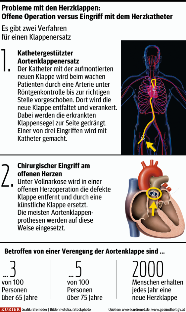 Herzklappe wie bei „Arnie“: Für wen diese Methode geeignet ist
