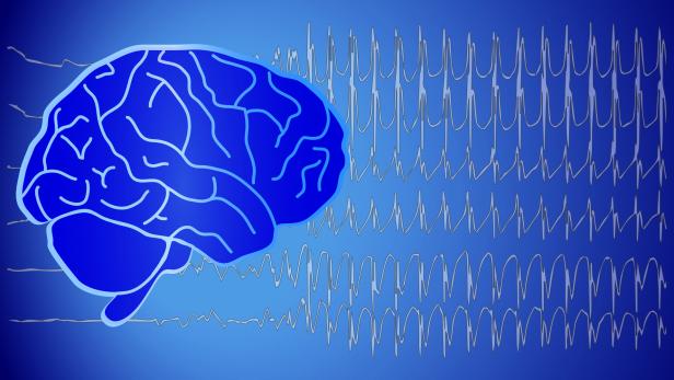 Epilepsie: Sieben von zehn Patienten könnten ohne Anfälle leben