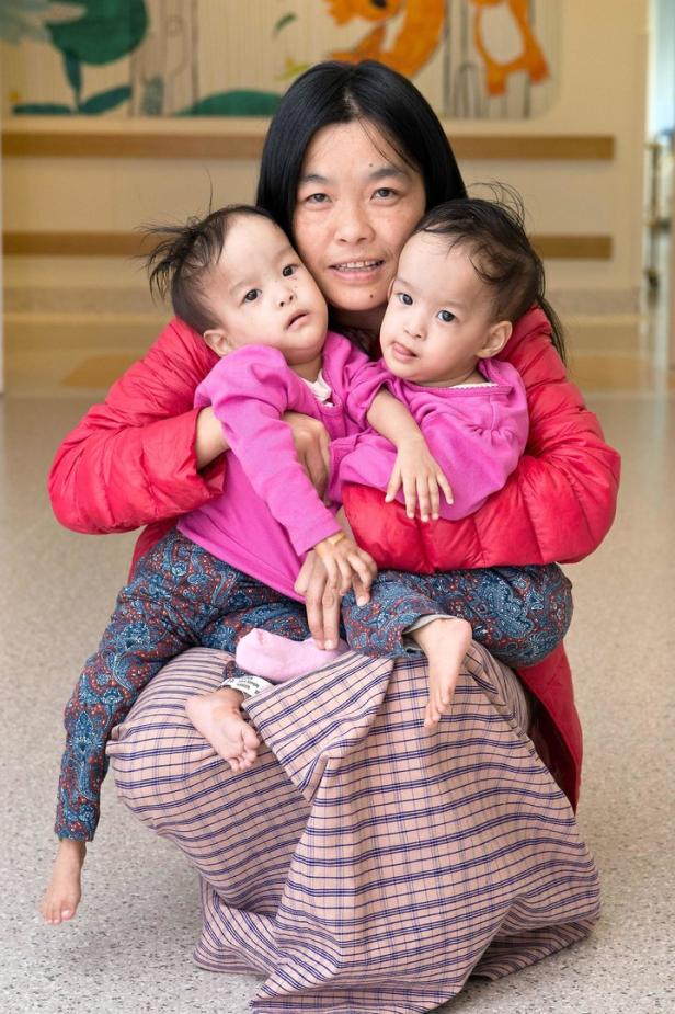 Erfolgreiche OP: Ärzte trennen siamesische Zwillinge aus Bhutan
