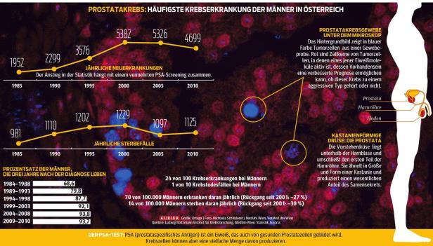 Besserer Test für Prostatakrebs