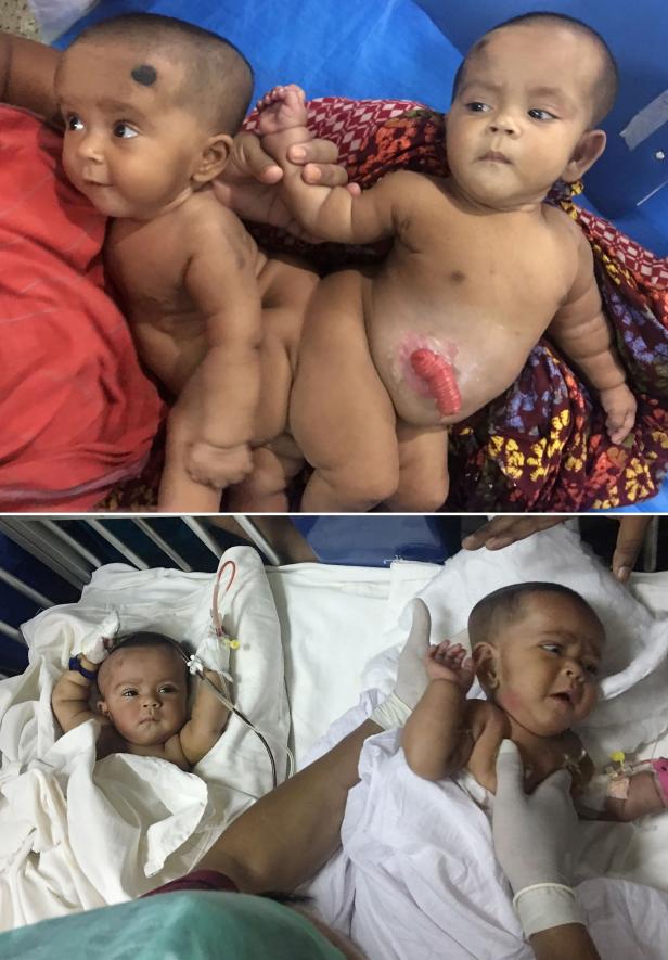 COMBO-FILES-BANGLADESH-HEALTH-DOCTORS-CONJOINED-TWINS