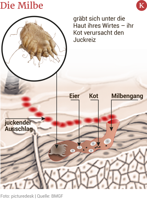 Juckender Hautausschlag Milben