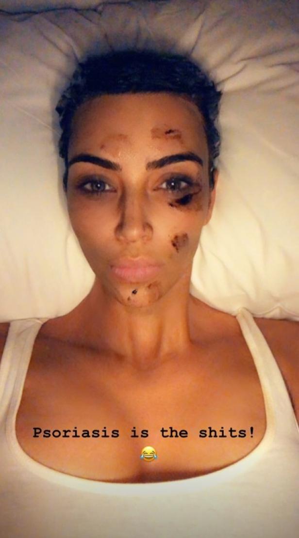 Reality-Star Kim Kardashian zeigt erstmals ihre Hautkrankheit