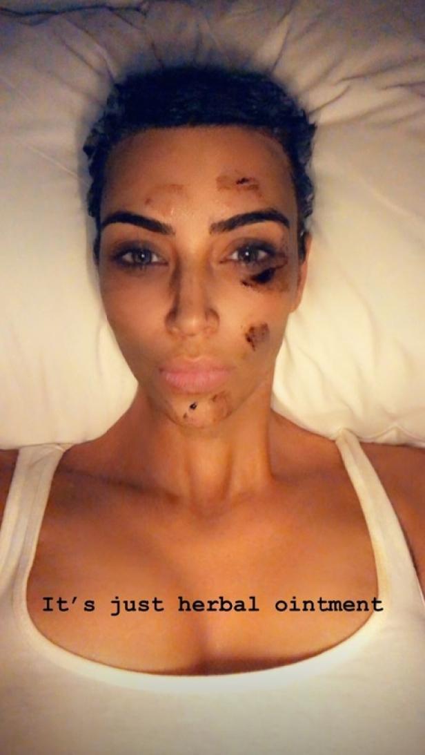 Reality-Star Kim Kardashian zeigt erstmals ihre Hautkrankheit
