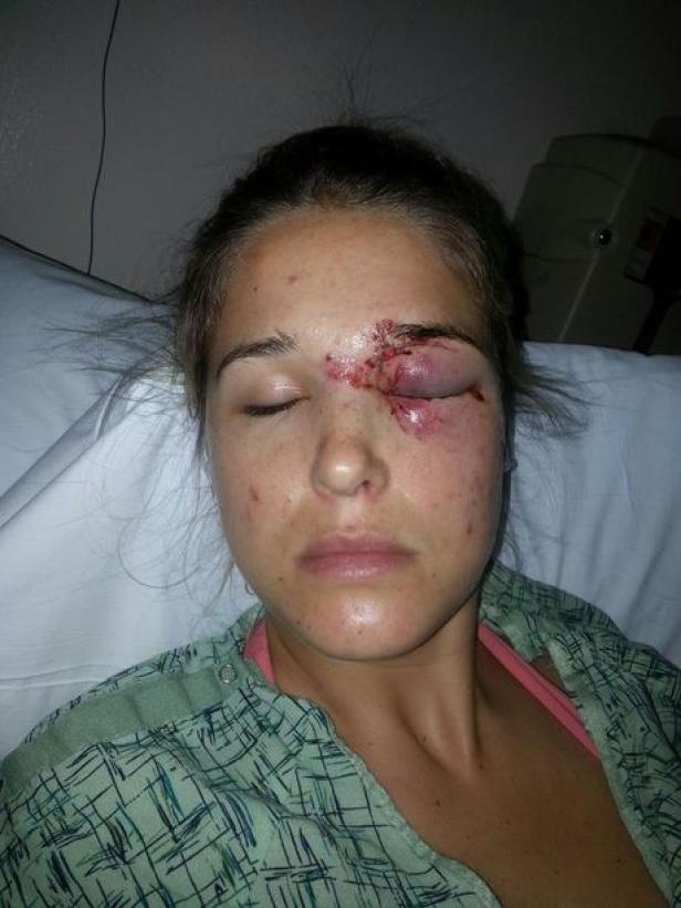 Eine Frau liegt mit einer schweren Augenverletzung im Krankenhaus.