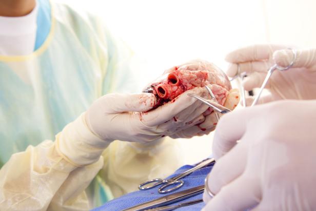 Erstmals in Österreich Herz nach Stillstand für Transplantation reanimiert