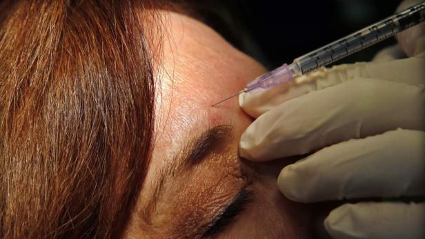 Botox: mehr als ein Antifaltenmittel