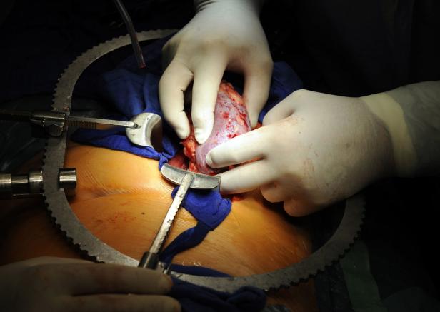 Nierentransplantation: Neues Gerät soll Organe verbessern